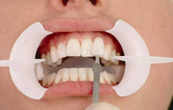 Tooth Whitening - Hartforde Dental Centre