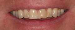 Veneers - Hartforde Dental Centre